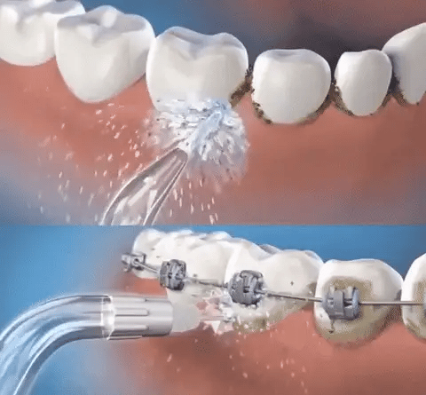 Irrigador bucal recargable - Combate el sarro y mal aliento